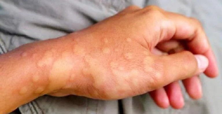 Cua C&agrave; Mau C&oacute; G&acirc;y Dị Ứng Kh&ocirc;ng? Dấu Hiệu Nhận Biết V&agrave; C&aacute;ch Xử L&yacute;