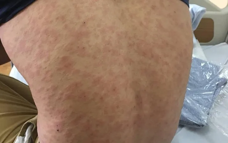 Dấu hiệu ngoài da nổi mề đay khi bị dị ứng cua biển